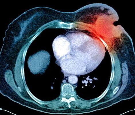 Will a Chest CT Scan Show Breast Cancer? Exploring the Intersection of Imaging and Oncology